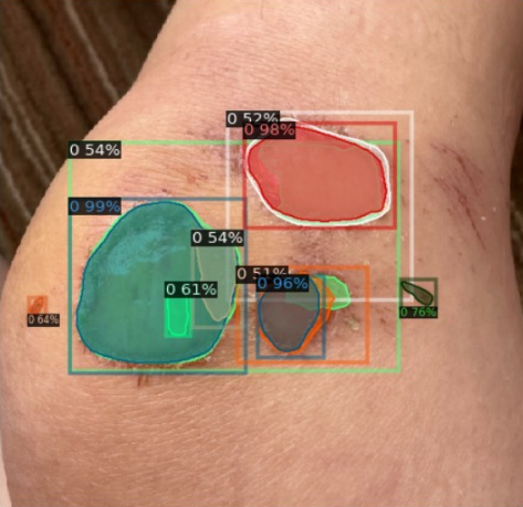 Wound Analysis Demo 2