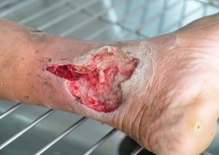 Wound Image 1A