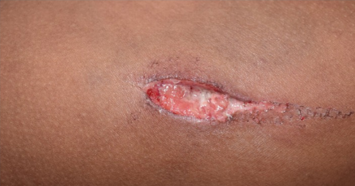 Wound Image 3A